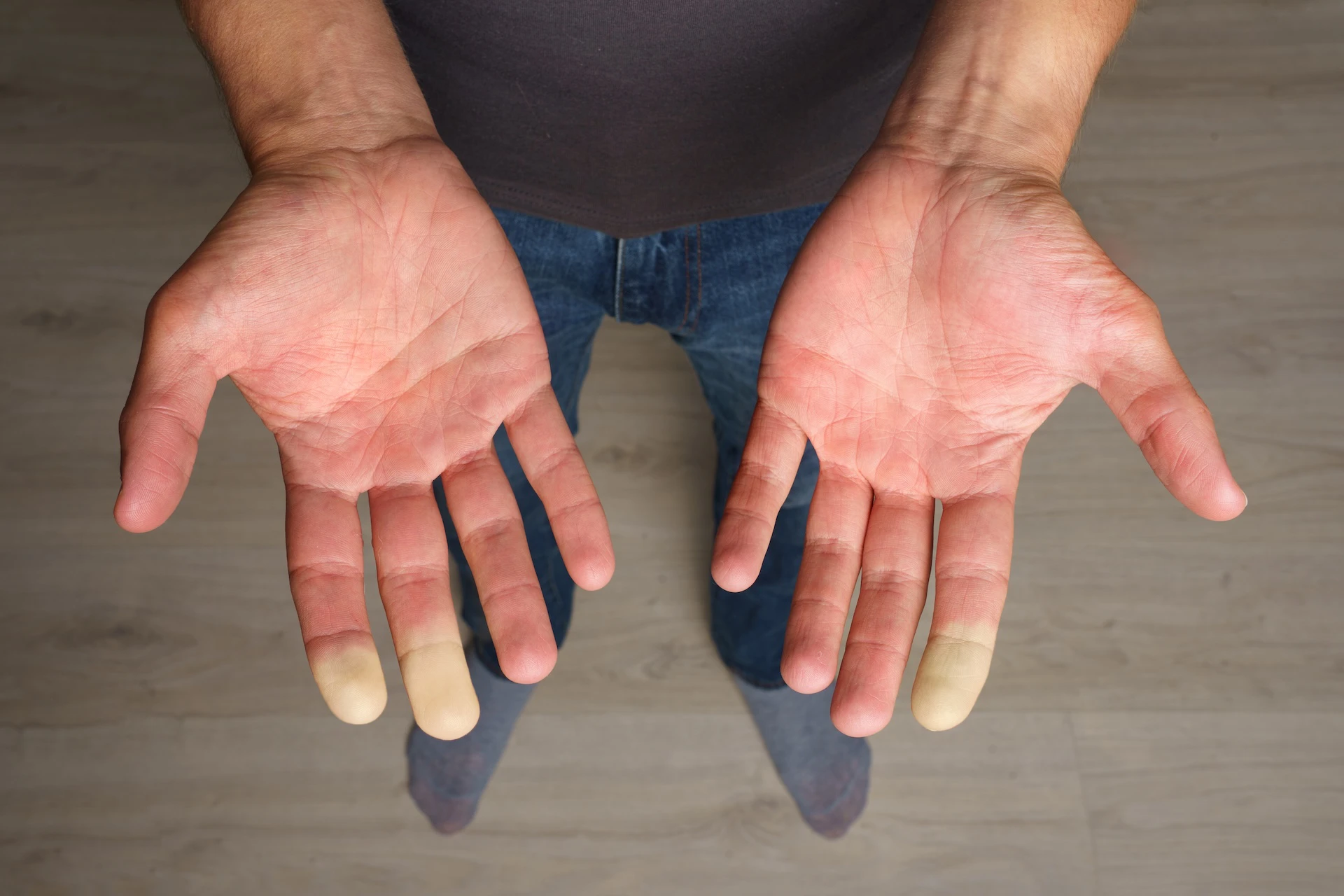 Close-up of a person’s outstretched hands showing pale, discoloured fingertips, commonly associated with Raynaud’s phenomenon.